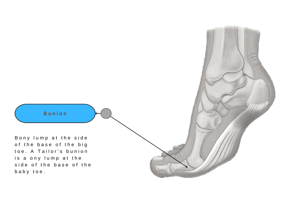 Bunion - Foot Pain