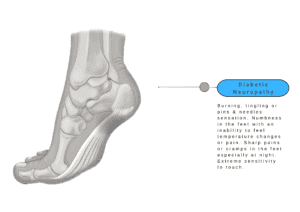 Diabetic Neuropathy - Foot Pain