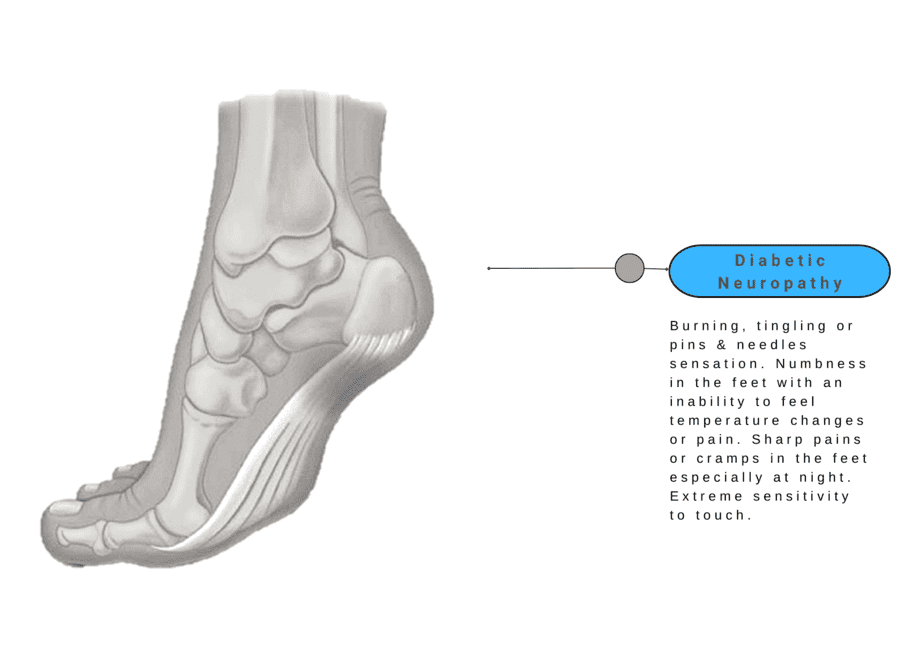 Diabetic Neuropathy - Foot Pain