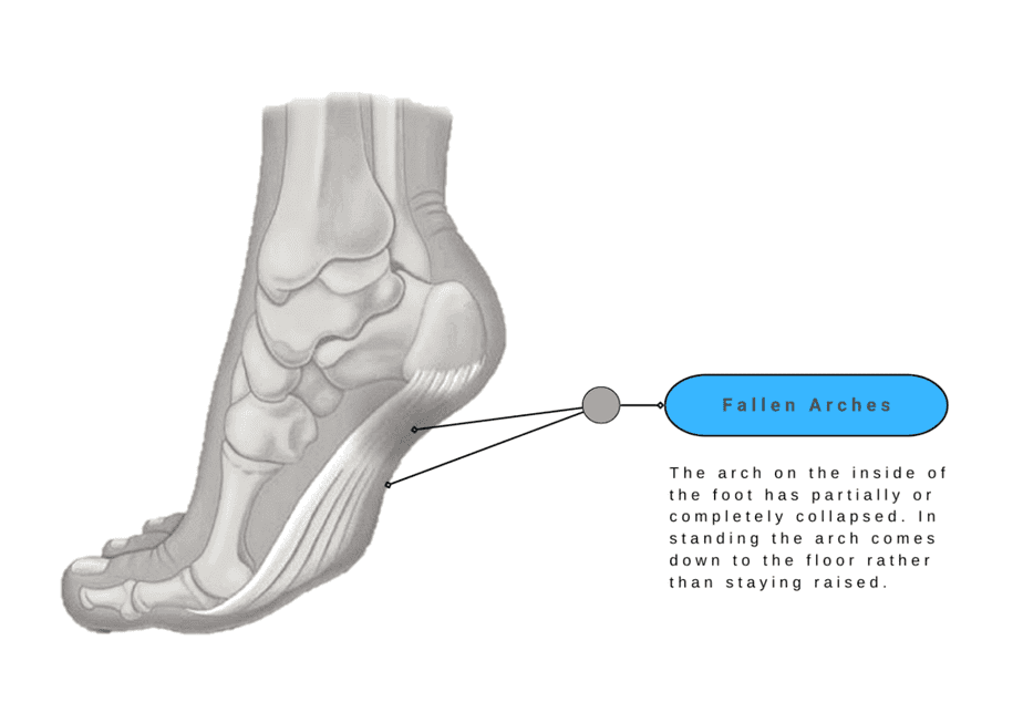 Fallen Arches - Foot Pain