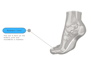 Hammer Toes - Foot Pain