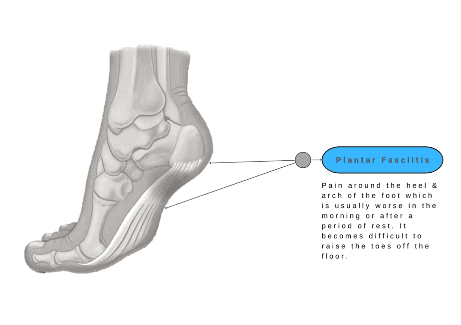 Plantar Fasciitis - Foot Pain