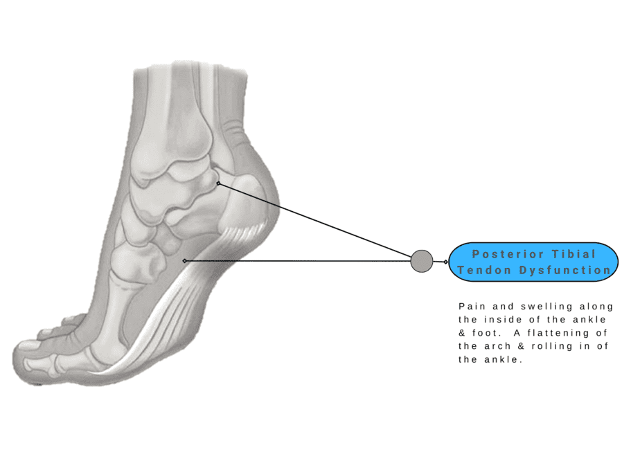 Posterior Tibial Tendon Dysfunction - Foot Pain